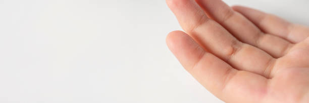 verruga en el dedo. primer plano de una verruga en el dedo de un niño. la verruga común verruga vulgaris es causada por un tipo de virus del papiloma humano, vph. - fotos de virus papiloma humano fotografías e imágenes de stock