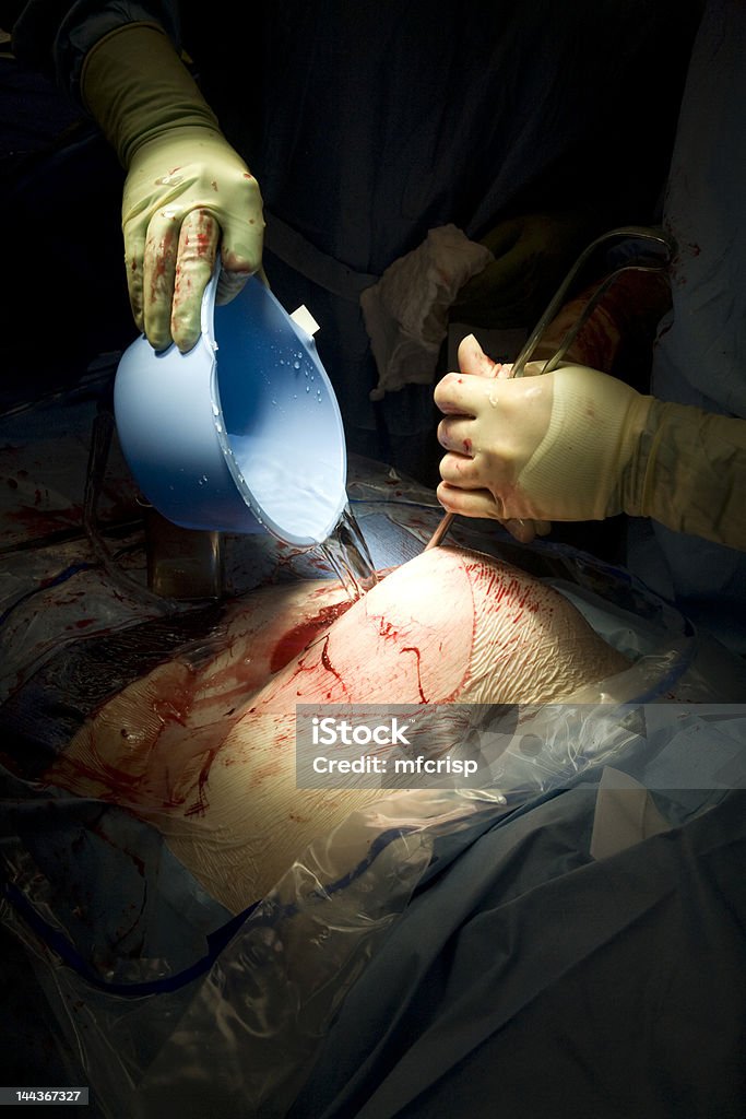 Irrigating during Surgery A nurse pours sterile water into the open wound of a surgery patient while the doctor holds open the stomach. Abdomen Stock Photo