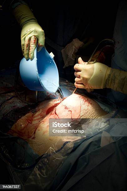 Irrigating During Surgery Stock Photo - Download Image Now - Abdomen, Blood, Caesarean Section