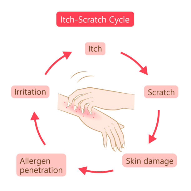 Itch Scratch Cycle Hands Illustration Dry Dermatitis And Atopic Eczema Itch Scratch Cycle Hands Illustration Dry Dermatitis And Atopic Eczema Condition Healthy 