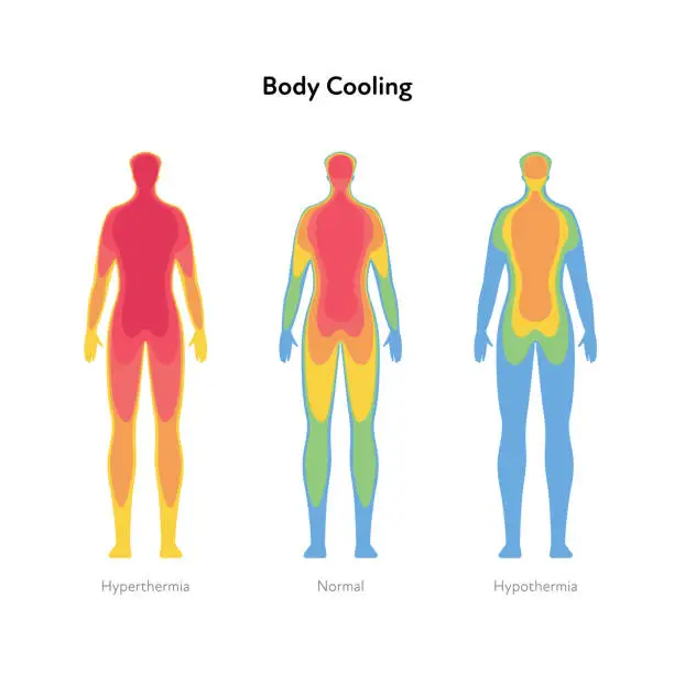 Vector illustration of Hyperthermia and hypothermia health care infographic. Vector flat healthcare illustration. Body cooling infrared heat map isolated on white background.
