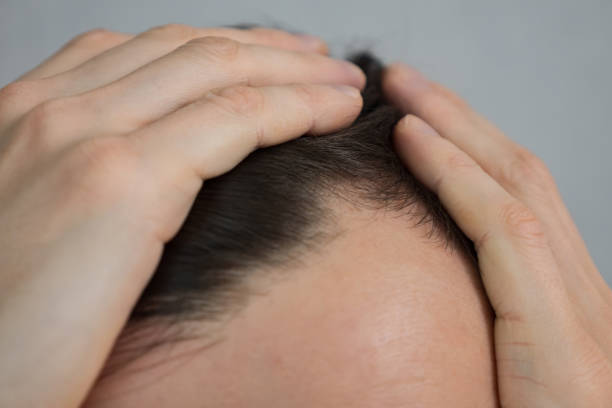 istock Young man touches hair with hands worrying about baldness 1443912932