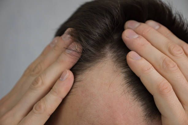 istock Young man touches hair with hands worrying about baldness 1443912933