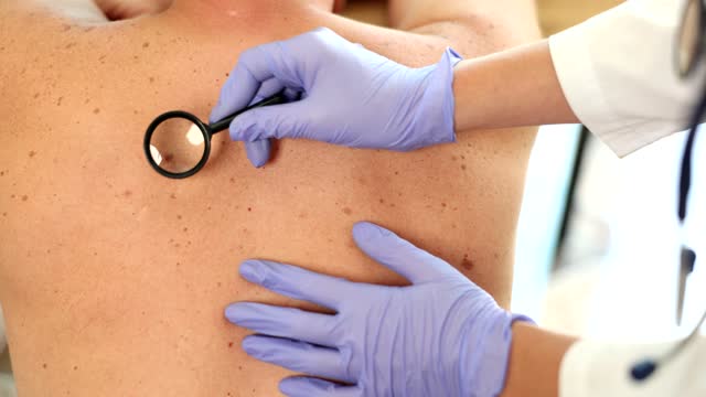 Dermatologist examines skin on patient back closeup