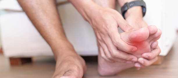 man having bunion toes or blister due to wearing narrow shoes and waking or running longtime, barefoot pain due to Plantar fasciitis. Health and medical concept man having bunion toes or blister due to wearing narrow shoes and waking or running longtime, barefoot pain due to Plantar fasciitis. Health and medical concept obese joint pain stock pictures, royalty-free photos & images