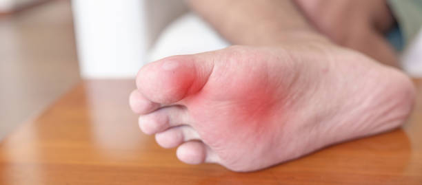 man having bunion toes or blister due to wearing narrow shoes and waking or running longtime, barefoot pain due to plantar fasciitis. health and medical concept - longtime imagens e fotografias de stock