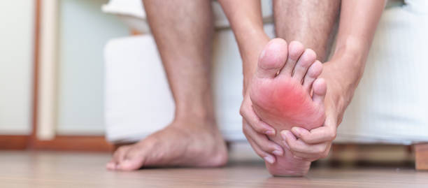 homme ayant des douleurs pieds nus dues à une fasciite plantaire et des orteils ou des ampoules en raison du port de chaussures étroites et du réveil ou de la course de longue date. santé et concept médical - longtime photos et images de collection