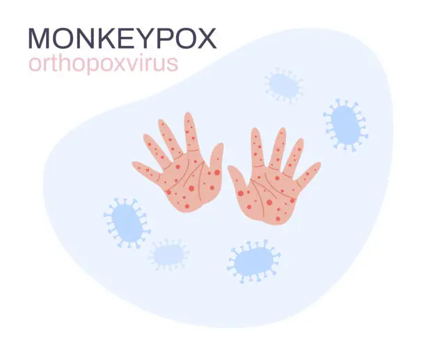 Vector illustration of Illustration of rash on palms of hands  for informing people about monkeypox virus symptoms