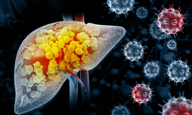 Liver cancer or liver tumor, Hepatocellular carcinoma (HCC), causes, symptoms, treatments, 3d illustration stock photo