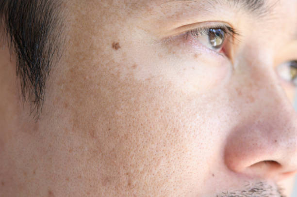 Close up Asian man face with freckles dark spots from uv light , skin care and health problem concept stock photo