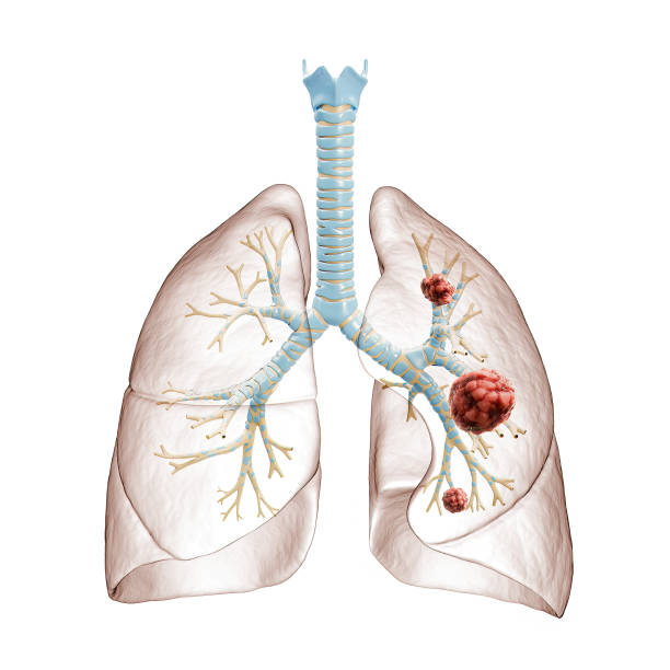 Lung cancer or carcinoma 3D rendering illustration. Bronchial tree and lungs infected by cancer cells on white background. Medical, healthcare, oncology, disease, science concept. stock photo