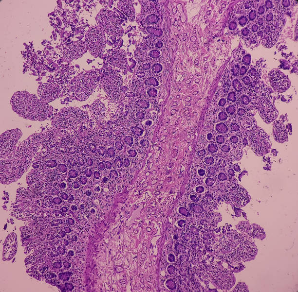 istock Intra abdominal mass with transverse colon(biopsy): Fibromatosis. 1445085477