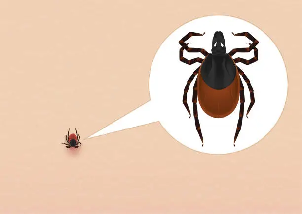 Vector illustration of The ixodic tick has stuck to the skin. An ixodic tick in magnification. The carrier of Lyme borreliosis and encephalitis.