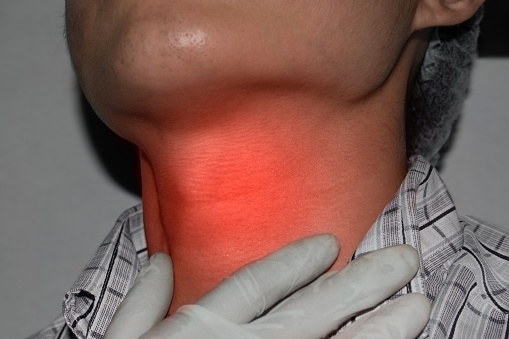 Redness at neck of Asian, Myanmar young man. Concept of sore throat, pharyngitis, laryngitis, thyroiditis, hyperthyroidism or dysphagia.