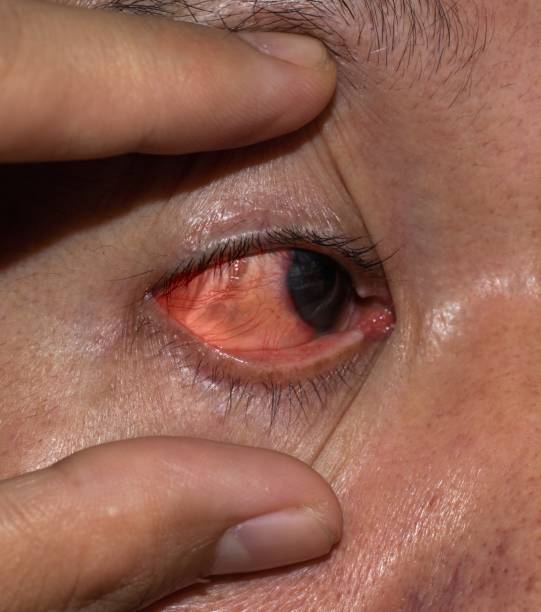 istock Corneal infection or ulcer called keratitis in Asian man. 1445301251
