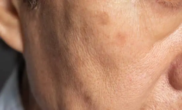 Enlarged pores in face of Southeast Asian, Chinese elder man
