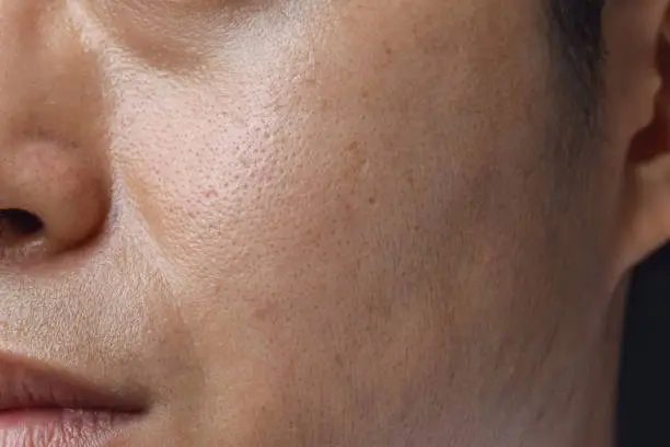 Photo of Fair skin with wide pores in face of Asian, Myanmar or Korean man.