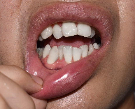 Stacked or overlapping white teeth of Asian man. Also called crowded teeth.