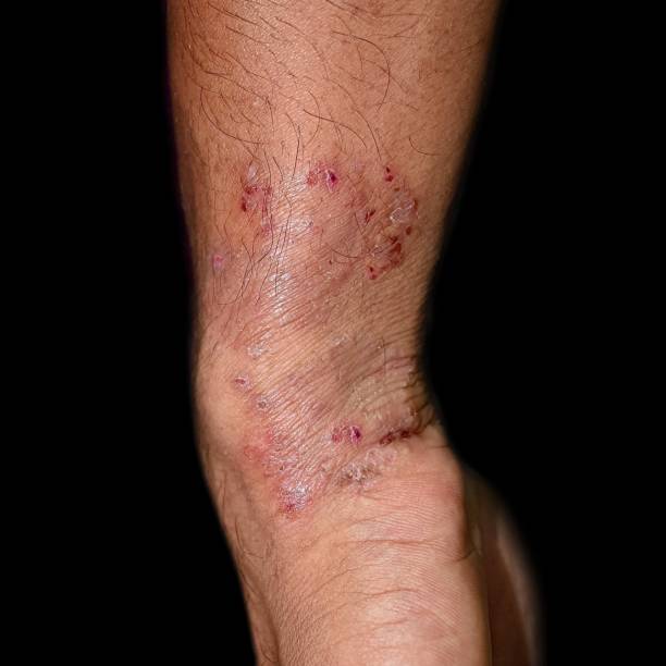 Fungal Infection Called Tinea Corporis Stock Photo - Image of dark,  infection: 260070088