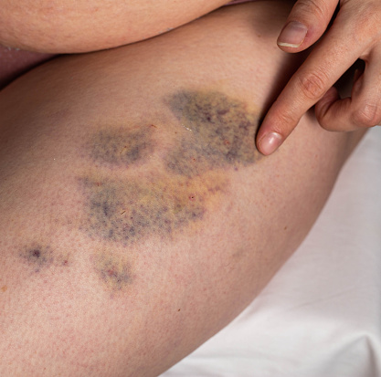 Treatment of bruises, bumps and seals after injections with therapeutic ointment. Rubbing a medicinal ointment into the injection and bruising sites.
