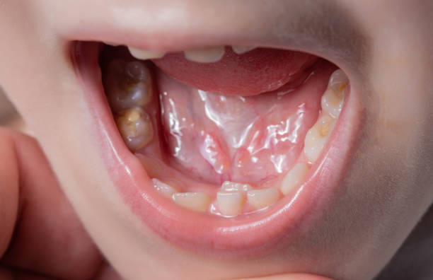 istock A permanent molar in a child grows second row. Incorrect growth of molars or polyodontia in dentistry, close-up 1445391761