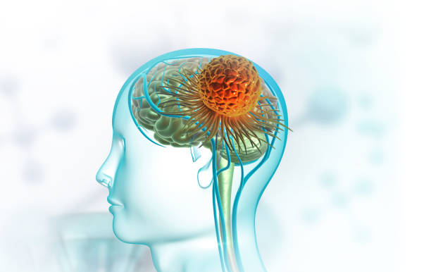 istock Brain tumor medical concept 1445395871