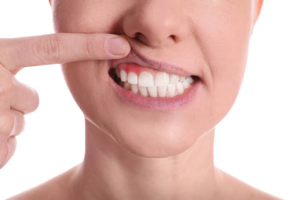 Woman showing inflamed gums on white background, closeup view Woman showing inflamed gums on white background, closeup view abscess stock pictures, royalty-free photos & images