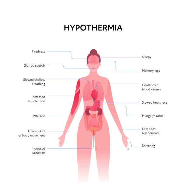 凍傷と低体温症のヘルスケアインフォグラフィックコレクション。ベクターフラットデザインヘルスケアイラスト。テキスト付きの低体温警告サインを持つ内臓を持つ女性の体の解剖学的ス� - anatomical model点のイラスト素材／クリップアート素材／マンガ素材／アイコン素材