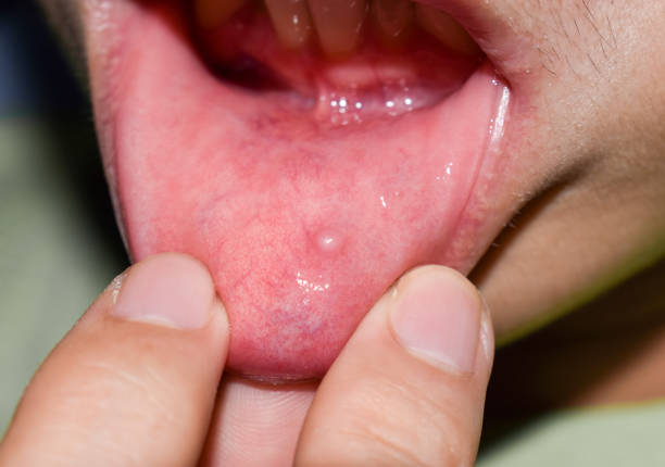 istock Small vesicle lesion at lower lip 1445505443