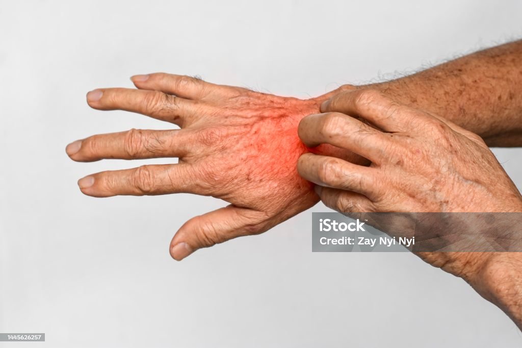 Asian man scratching his hand. Concept of itchy skin diseases such as scabies, fungal infection, eczema, psoriasis, allergy, etc. Asian elder man scratching his hand. Concept of itchy skin diseases such as scabies, fungal infection, eczema, psoriasis, allergy, etc. Dry Stock Photo