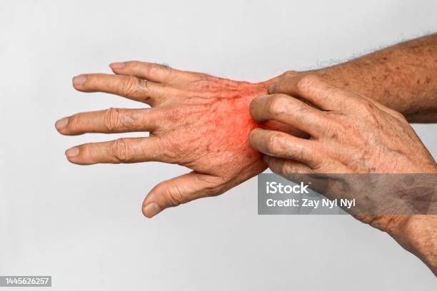 Asian Man Scratching His Hand Concept Of Itchy Skin Diseases Such As Scabies Fungal Infection Eczema Psoriasis Allergy Etc Stock Photo - Download Image Now