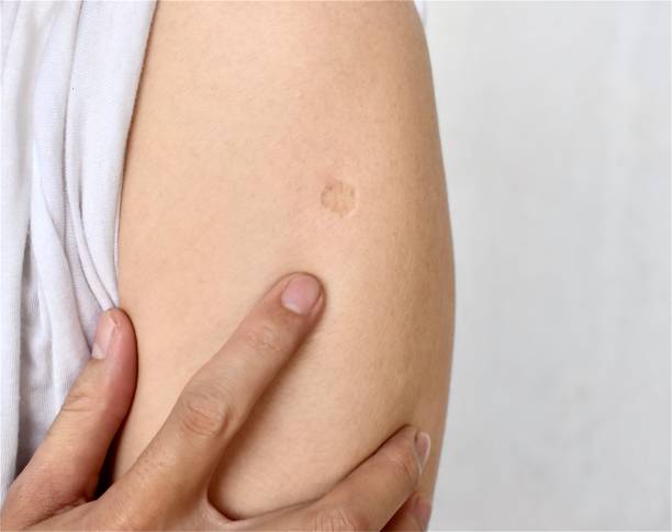 бцж или противотуберкулезная вакцина отметина на руке азиатского мужчины. - oval shape фотографии стоковые фото и изображения