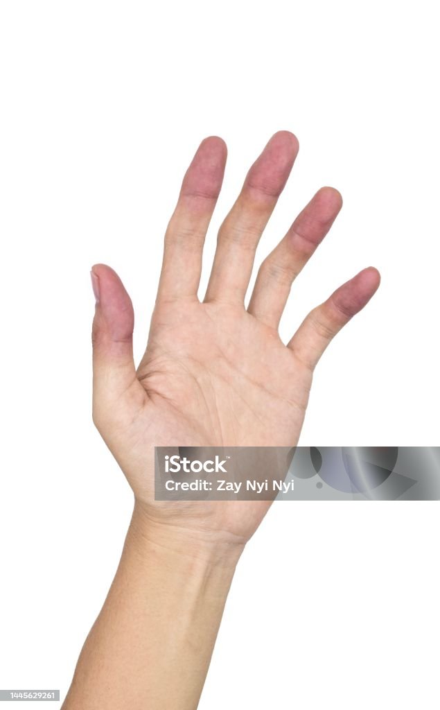 Painful palmar aspect of Asian man. Concept of compartment syndrome. Painful palmar aspect of Asian young man. Concept of compartment syndrome and hand muscles pain. Adult Stock Photo