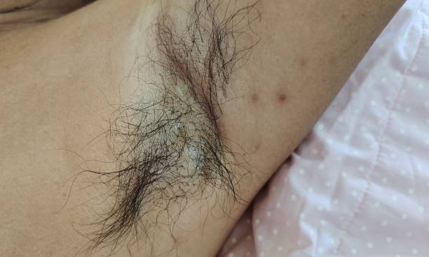 istock The dermatitis inflammation under the arm, armpit hair underarm. 1445663786