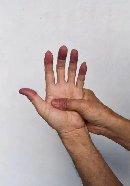 Cyanotic hands or peripheral cyanosis or blue hands at Southeast Asian, Chinese old man