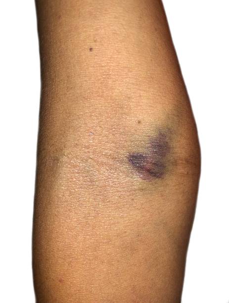 prellungen am ellenbogen eines asiatischen patienten. intravenöse nadelverletzung. - iv bruise stock-fotos und bilder