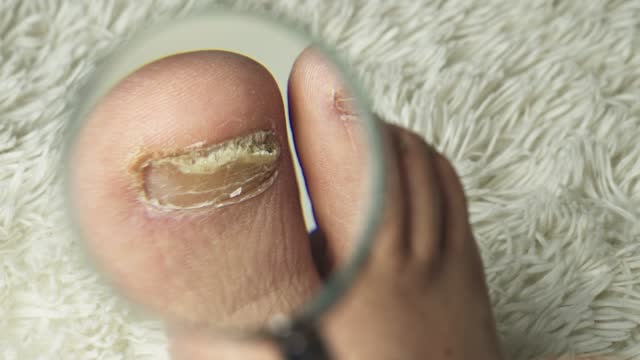 A man examines with a magnifying glass a toenail affected by a fungus.