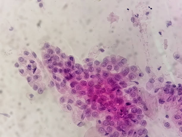 Microscopic view of Trichomonas vaginalis in pap smear with few acute inflammatory cells. Cytology and pathology laboratory department. Sexually transmitted disease. Trichomoniasis stock photo