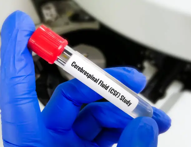 Photo of Cerebrospinal fluid (CSF) study including biochemistry, cytology, Gram staining.