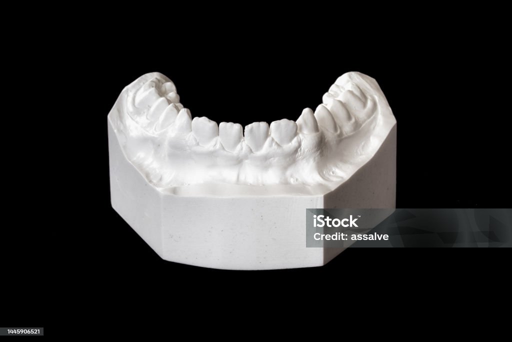 Plaster cast of a denture bite of a 13 year old person for medical examination Anatomy Stock Photo