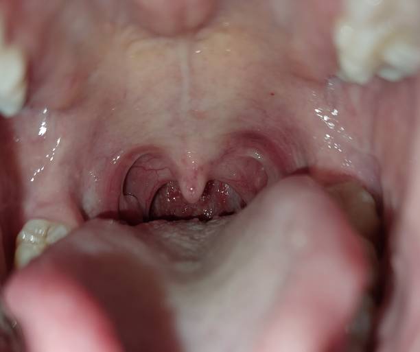 istock Pharyngitis and tonsillitis is infected on throat 1446157277