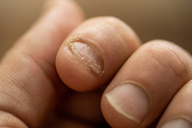 Onychophagy. Close up of fingers with eaten nail. Anxiety and nerves. Onychophagy. Close up of fingers with eaten nail. Anxiety and nerves. in Mar del Plata, Buenos Aires Province, Argentina nail biting stock pictures, royalty-free photos & images