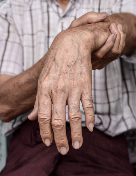 istock Radial nerve injury or wrist drop 1446402589