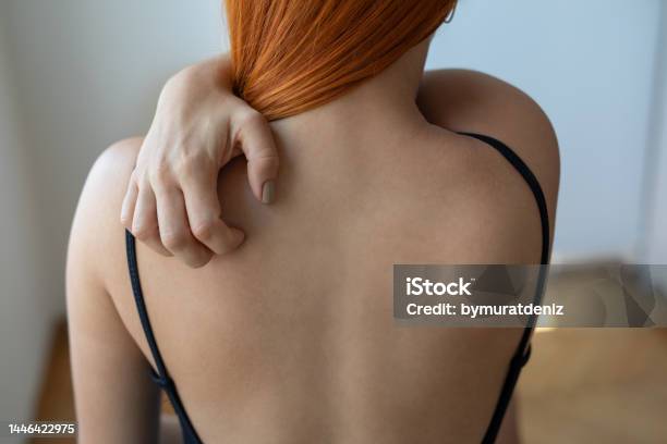Woman With Skin Problem Stock Photo - Download Image Now - Skin, Scratching, Women