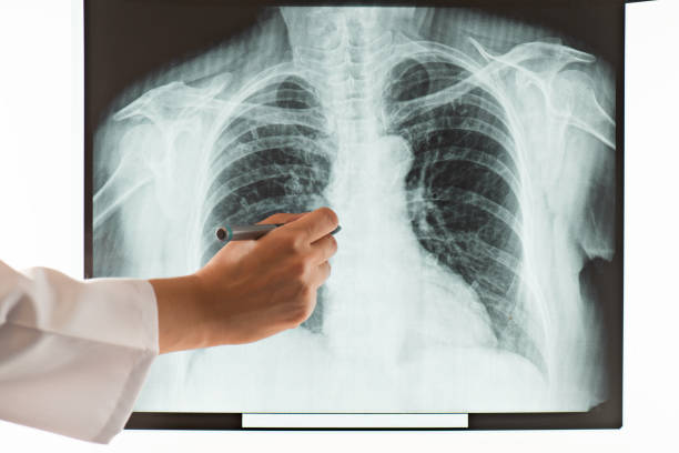 istock X-Ray of Shoulder 1446488822