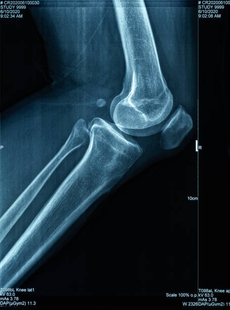 人間の脚と膝のx線画像 - cartilage patella human knee medical exam ストックフォトと画像