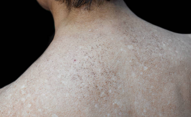 istock Age spots and white patches on upper back. They are brown, gray, or black spots and also called liver spots, senile lentigo, solar lentigines, or sun spots. 1446617660