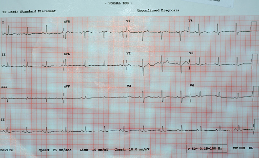 Deceased. Illustration of an electrocardiogram (ECG / EKG).