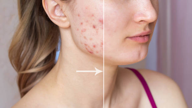 istock A young woman's face before and after acne  treatment on face. Pimples, red scars 1446724740