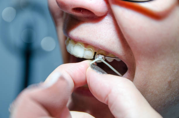 istock Close-up on woman removing elastic from dental braces 1446806821